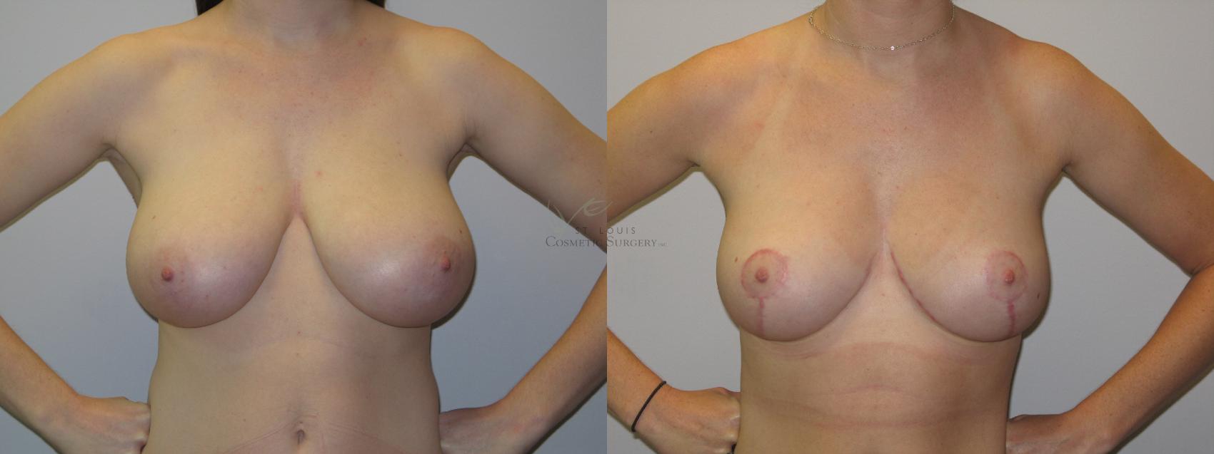 Before & After Breast Reduction Case 15 View #1 View in St. Louis, MO