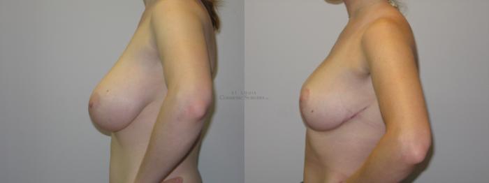Before & After Breast Reduction Case 15 View #2 View in St. Louis, MO