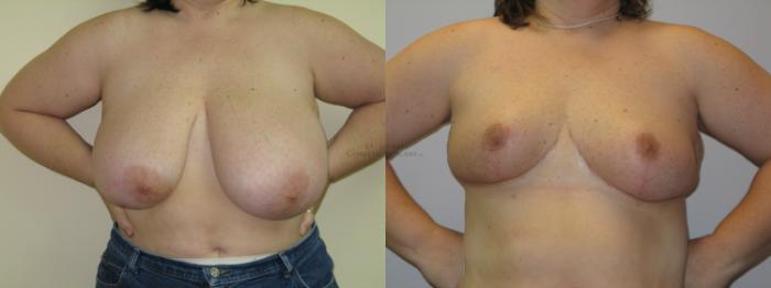 Before & After Breast Reduction Case 16 View #1 View in St. Louis, MO
