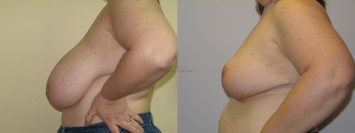 Before & After Breast Reduction Case 16 View #2 View in St. Louis, MO