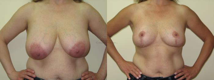 Before & After Breast Reduction Case 17 View #1 View in St. Louis, MO