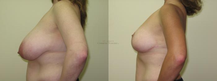 Before & After Breast Reduction Case 17 View #2 View in St. Louis, MO