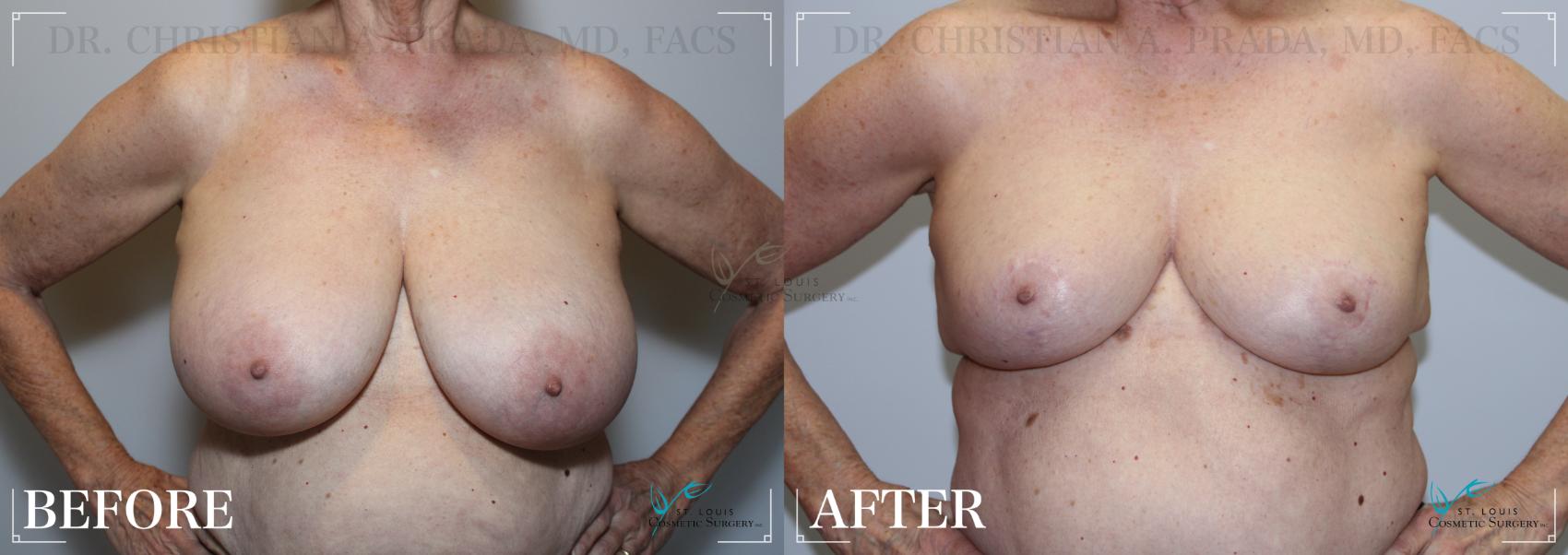 Before & After Breast Reduction Case 213 Front View in St. Louis, MO