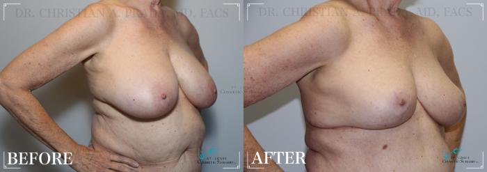 Before & After Breast Reduction Case 213 Right Oblique View in St. Louis, MO