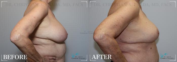 Before & After Breast Reduction Case 213 Right Side View in St. Louis, MO