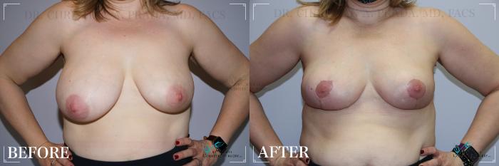 Before & After Breast Lift Case 276 Front View in St. Louis, MO