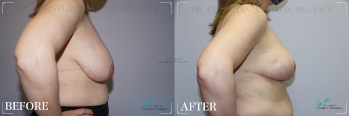Before & After Breast Lift Case 276 Right Side View in St. Louis, MO