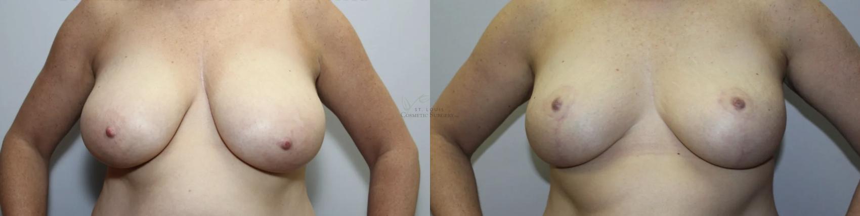 Before & After Breast Reduction Case 300 Front View in St. Louis, MO