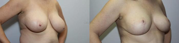 Before & After Breast Reduction Case 300 Right Oblique View in St. Louis, MO