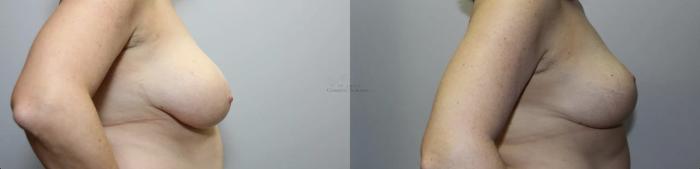Before & After Breast Reduction Case 300 Right Side View in St. Louis, MO