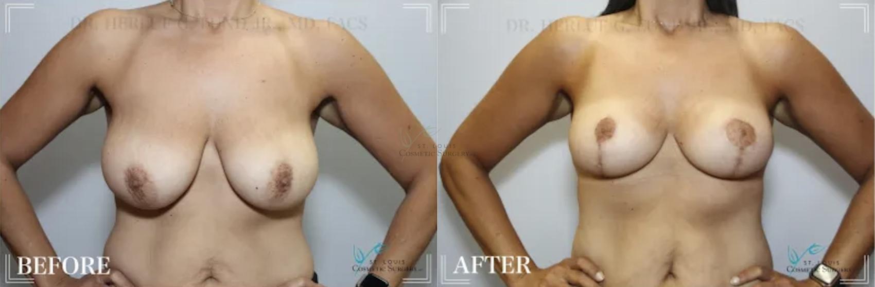 Before & After Breast Reduction Case 301 View #1 View in St. Louis, MO