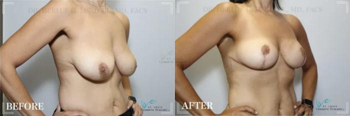 Before & After Breast Reduction Case 301 View #2 View in St. Louis, MO