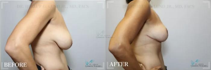 Before & After Breast Reduction Case 301 View #3 View in St. Louis, MO