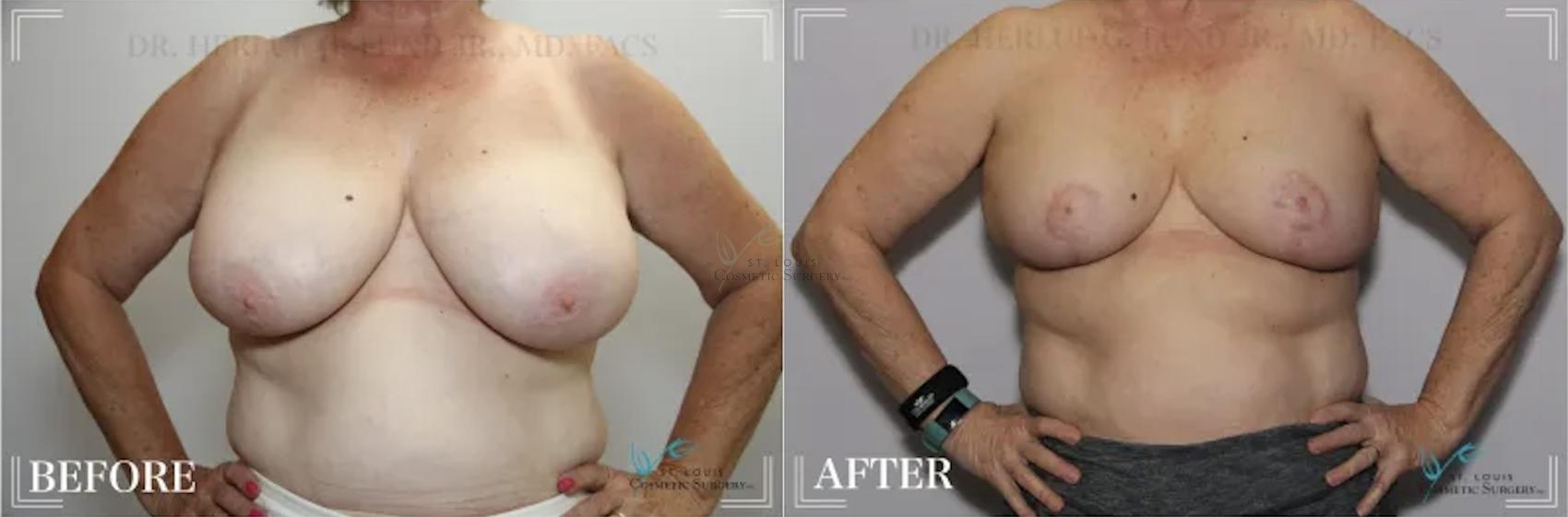 Before & After Breast Reduction Case 302 View #1 View in St. Louis, MO