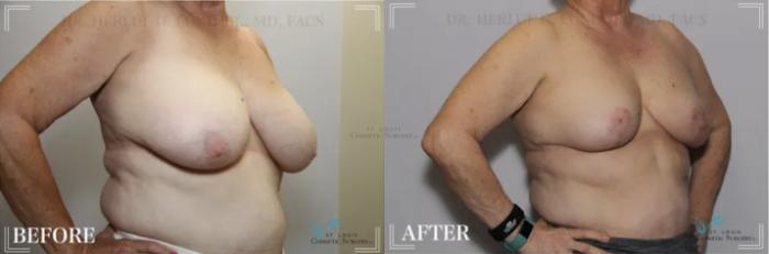 Before & After Breast Reduction Case 302 View #2 View in St. Louis, MO