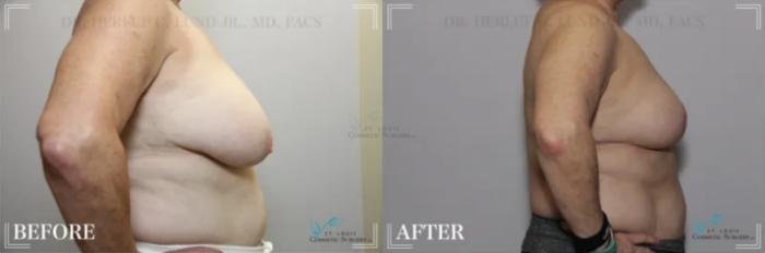 Before & After Breast Reduction Case 302 View #3 View in St. Louis, MO