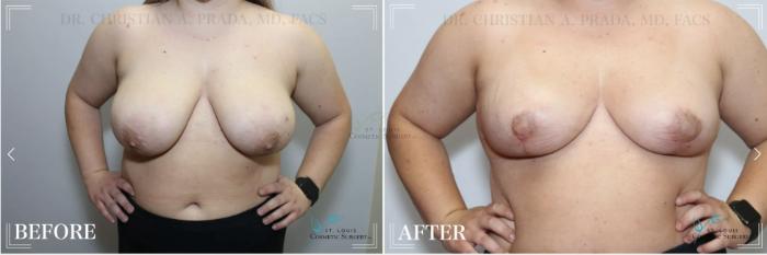 Before & After Breast Reduction Case 325 View #1 View in St. Louis, MO