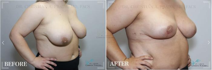 Before & After Breast Reduction Case 325 View #2 View in St. Louis, MO