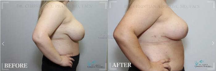 Before & After Breast Reduction Case 325 View #3 View in St. Louis, MO