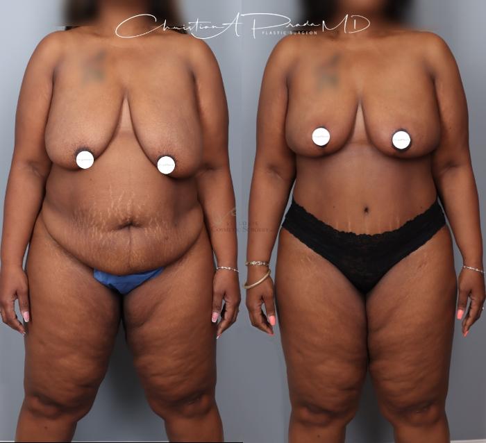 Before & After Breast Reduction Case 404 Front View in St. Louis, MO