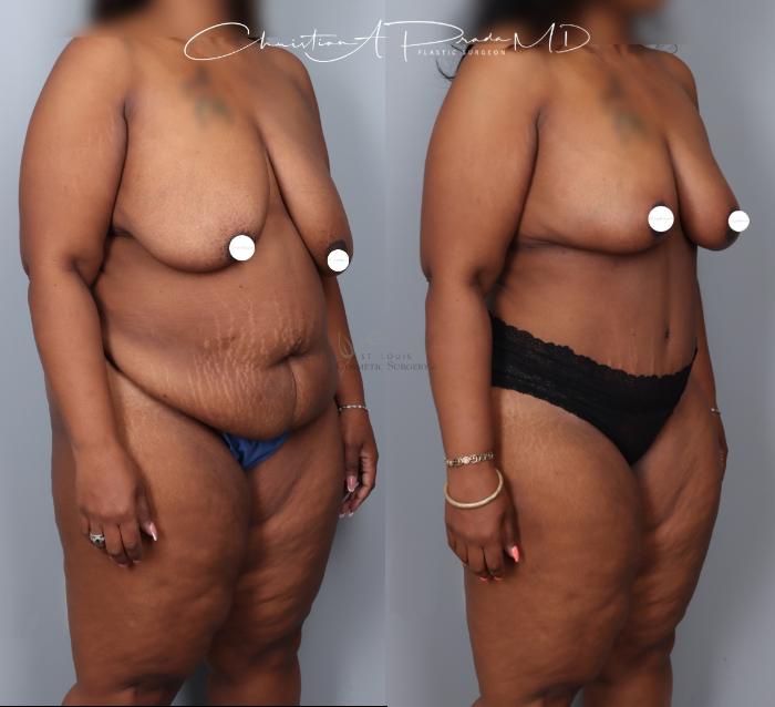Before & After Breast Reduction Case 404 Left Oblique View in St. Louis, MO