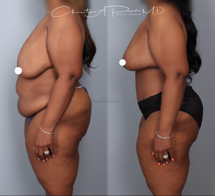 Before & After Breast Reduction Case 404 Left Side View in St. Louis, MO