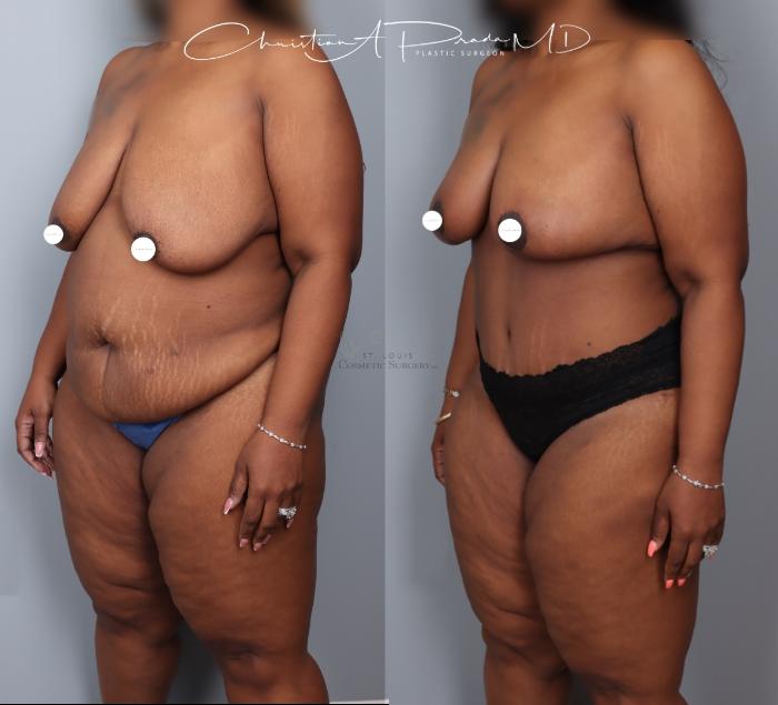 Before & After Breast Reduction Case 404 Right Oblique View in St. Louis, MO