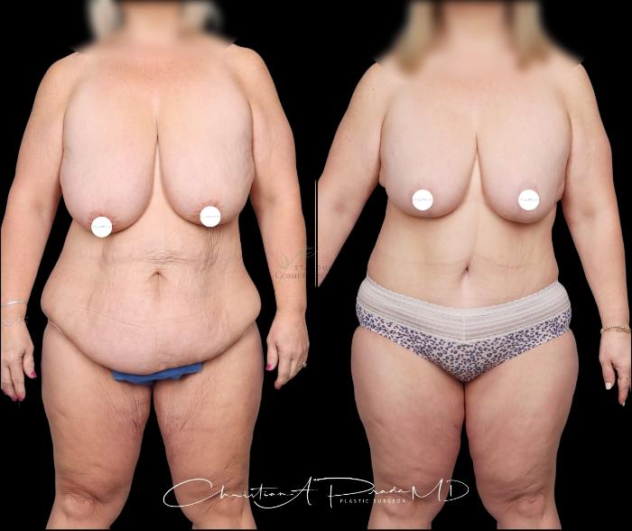 Before & After Mommy Makeover Case 405 Front View in St. Louis, MO