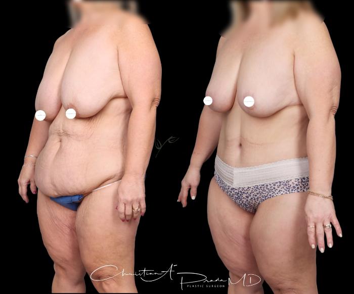 Before & After Mommy Makeover Case 405 Left Oblique View in St. Louis, MO