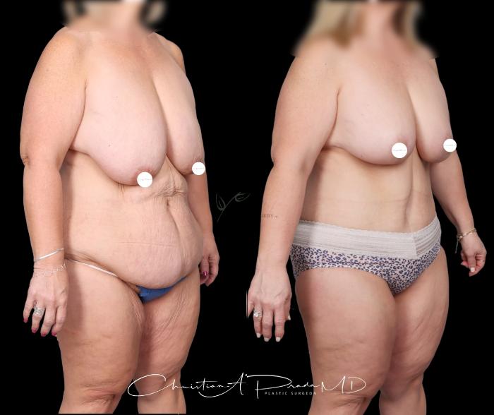 Before & After Mommy Makeover Case 405 Right Oblique View in St. Louis, MO