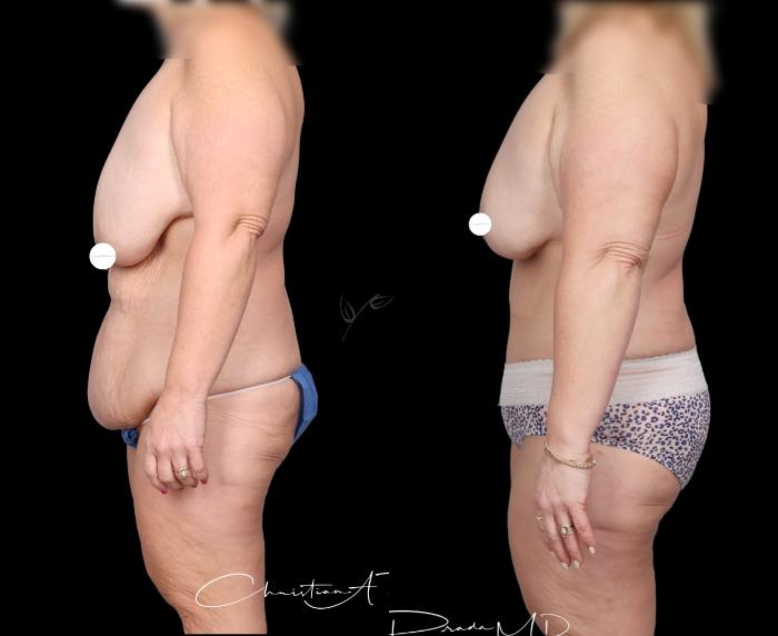 Before & After Mommy Makeover Case 405 Right Side View in St. Louis, MO