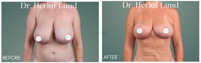 Before & After Breast Reduction Case 409 Front View in St. Louis, MO