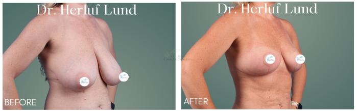 Before & After Breast Reduction Case 409 Left Oblique View in St. Louis, MO