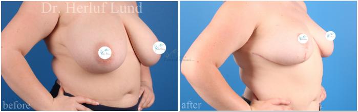 Before & After Breast Reduction Case 454 Left Oblique View in St. Louis, MO