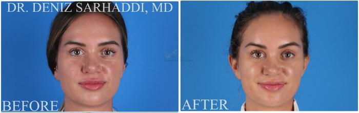 Before & After Brow Lift Case 388 Front View in St. Louis, MO