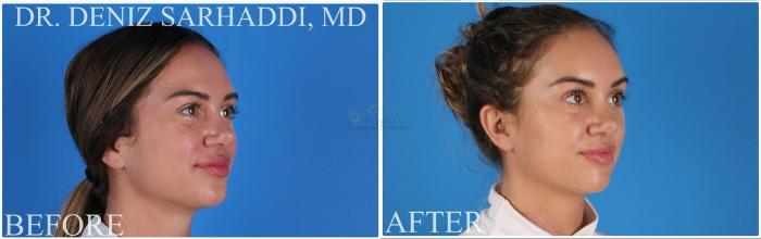 Before & After Brow Lift Case 388 Left Oblique View in St. Louis, MO