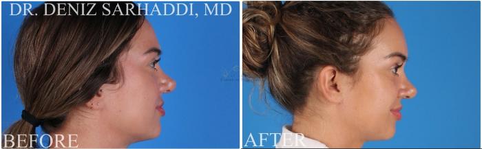 Before & After Brow Lift Case 388 Left Side View in St. Louis, MO