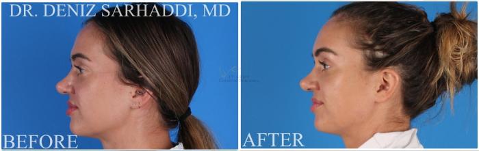 Before & After Brow Lift Case 388 Right Side View in St. Louis, MO