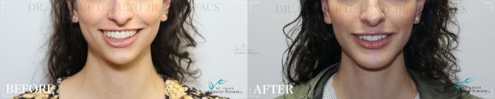 Before & After Chin Enhancement Case 182 Front View in St. Louis, MO