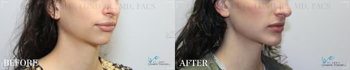 Before & After Chin Enhancement Case 182 Right Oblique View in St. Louis, MO