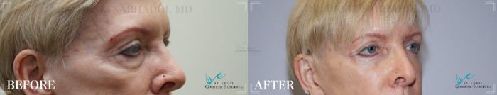 Before & After Eyelid Surgery Case 186 Right Oblique View in St. Louis, MO