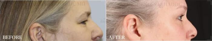 Before & After Eyelid Surgery Case 316 View #1 View in St. Louis, MO