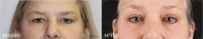 Before & After Eyelid Surgery Case 316 View #2 View in St. Louis, MO
