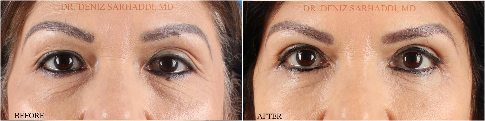 Before & After Eyelid Surgery Case 350 Front View in St. Louis, MO