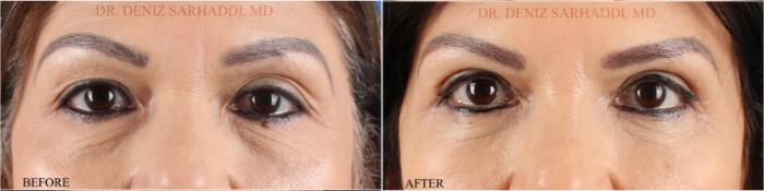 Before & After Eyelid Surgery Case 350 Front View in St. Louis, MO