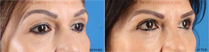 Before & After Eyelid Surgery Case 350 Left Oblique View in St. Louis, MO