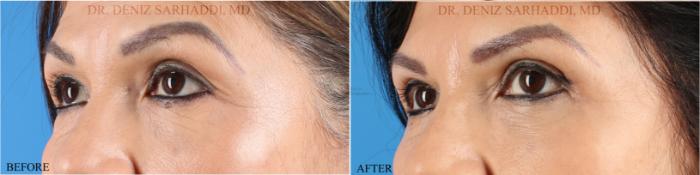 Before & After Eyelid Surgery Case 350 Right Oblique View in St. Louis, MO