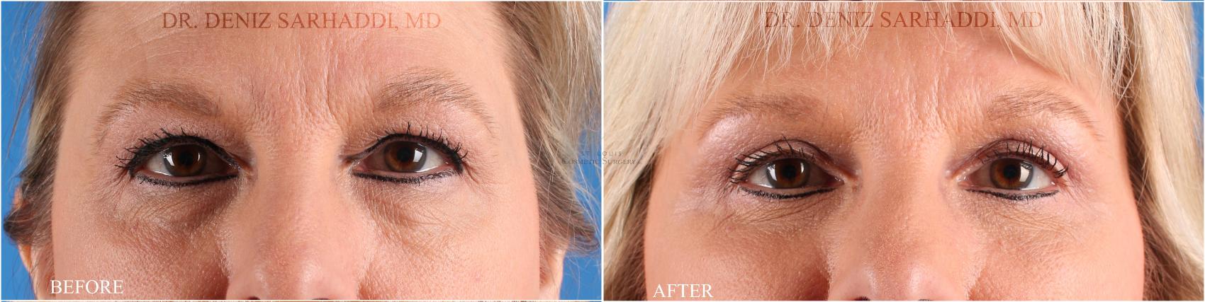 Before & After Eyelid Surgery Case 351 Front View in St. Louis, MO