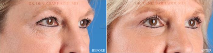 Before & After Eyelid Surgery Case 351 Left Oblique View in St. Louis, MO