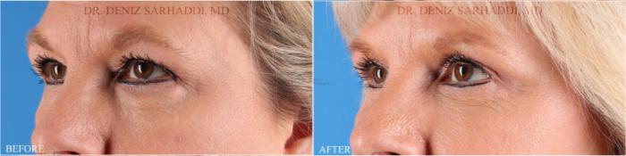 Before & After Eyelid Surgery Case 351 Right Oblique View in St. Louis, MO